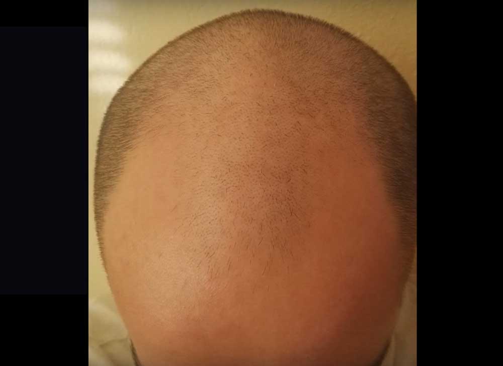 Bald and beautiful