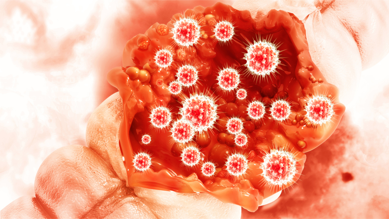 What you should know about colorectal cancer