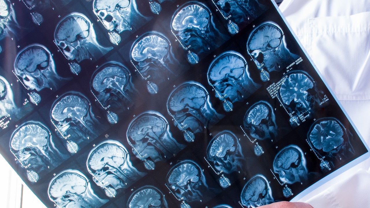 IISc researchers find new way to treat advanced brain cancer