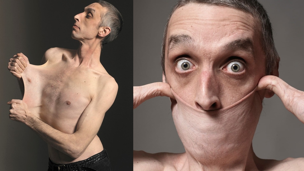 The Guinness record for the ‘most stretchable skin’ is with Garry Turner of UK.  He is able to stretch the skin of his stomach to a length of 15.8 cm (6.25 in). Credit: Instagram/guinnessworldrecords