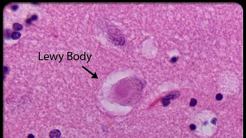 Lewy body