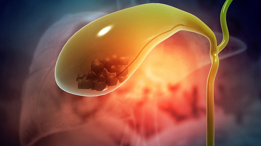 <div class="paragraphs"><p>Representative image of stone in a gallbladder.</p></div>