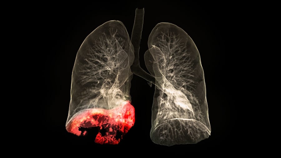 <div class="paragraphs"><p>Representative image for lung cancer.</p></div>