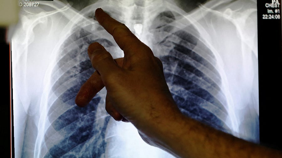 <div class="paragraphs"><p>Lung X-Ray. Representative image.</p></div>