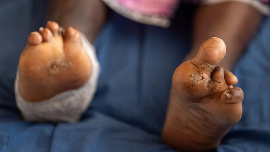 <div class="paragraphs"><p>A leprosy patient (Image for representation).</p></div>