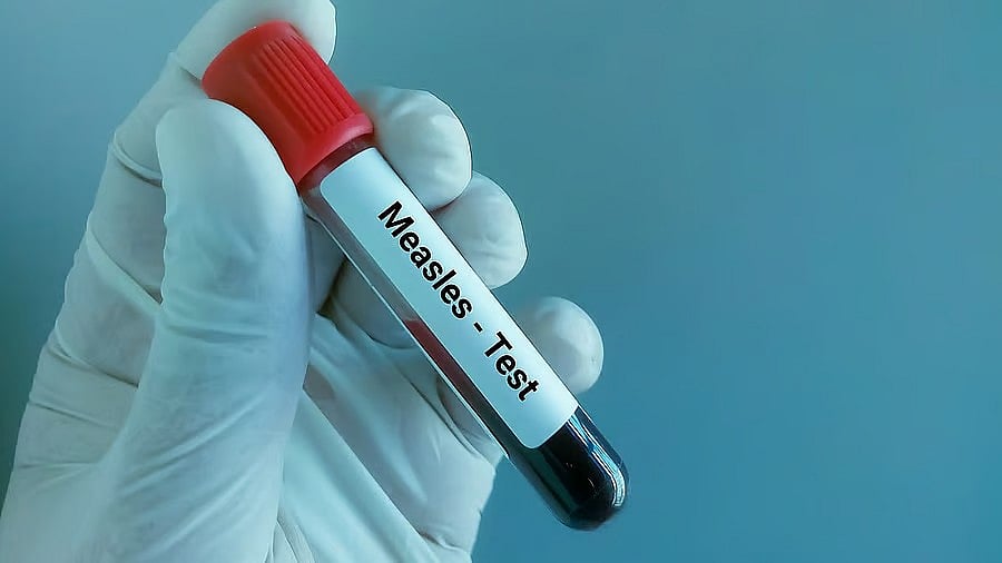 <div class="paragraphs"><p>Ten of the 11 patients had not received a single dose of the measles vaccine</p></div>