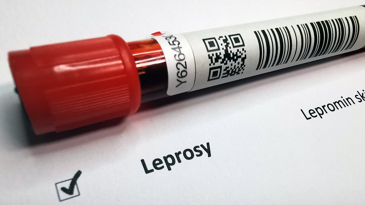 Dakshina Kannada Reports 47 Leprosy Cases in 2025, Health Officials Vigilant