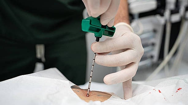 <div class="paragraphs"><p>Representative image of a&nbsp;bone marrow transplant.</p></div>