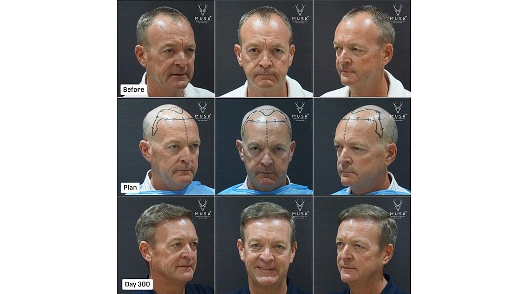 India's Medical Tourism Boom: How Musk Clinic Leads Global Aesthetics & Hair Restoration Demand