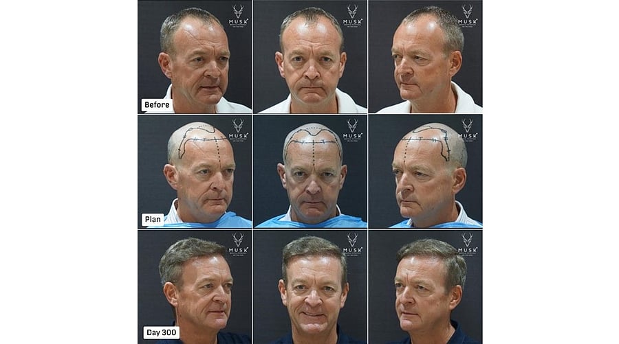 <div class="paragraphs"><p>Patient from Ireland, ARTAS Robotic FUE with 2,611 Hair Grafts (Before-After Hair Transplant Result)</p></div>