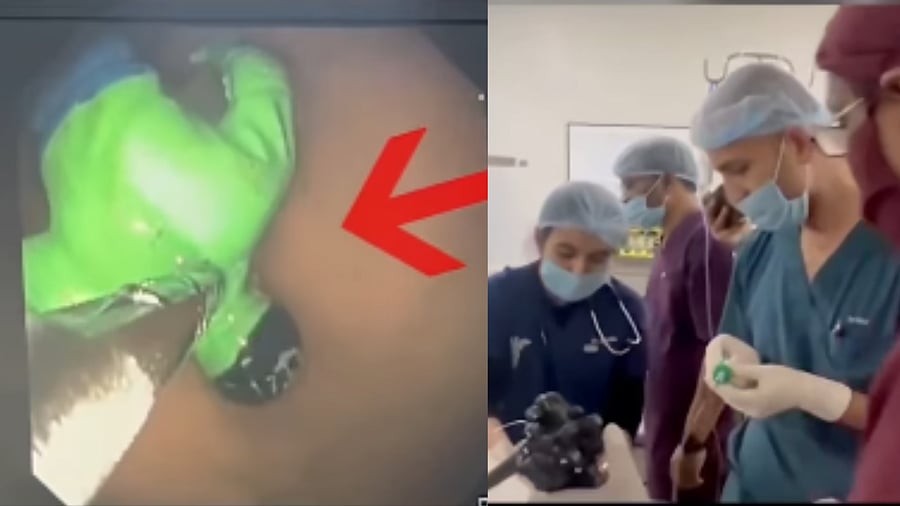 <div class="paragraphs"><p>Gujarat boy swallows ‘Hulk’ toy; doctors remove it via endoscopy.</p></div>