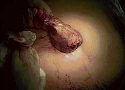 Large kidney tumour being removed through Single Incision Laparoscopic Donor Nephrectomy. dh photo