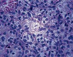 Cancerous: Researchers have developed a new method for tracking cancer by identifying the personalised biomarkers shed from tumour DNA.