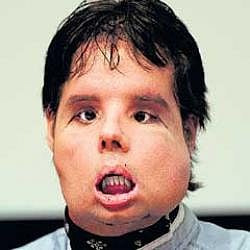 Oscar at a press conference  at Vall dHebron hospital in Barcelona on Monday. AFP