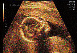 Tumour op in womb saves foetus