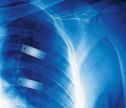 An X-ray of a rib cage with plate and screws (circled)