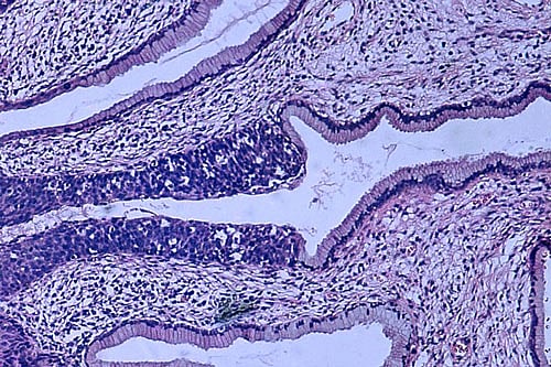 High grade dysplasia (carcinoma in situ) in the uterine cervix. The abnormal epithelium is extending into a mucus gland to the left of centre. This disease can progress to invasive cancer (squamous cell carcinoma) of the cervix. Wikipedia image