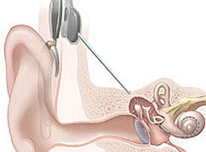 Scientists 'print' 3D bionic ear
