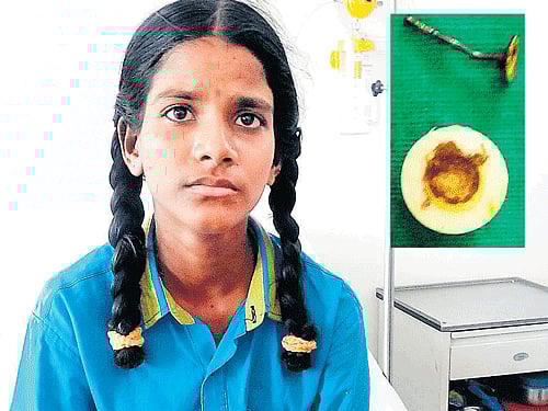 An ear stud (inset) that was found in 12-year-old Shanti's lung. She was operated upon at Rajiv Gandhi Institute of Chest Diseases and the foreign object was removed. DH Photo