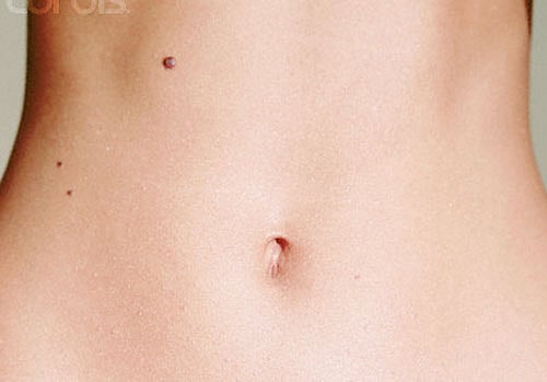 Patients with melanoma are at increased risk of developing a second primary melanoma. DH File Photo