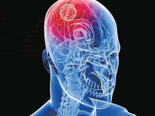 However, treatments for radiation necrosis and cancer recurrence are far different. Quick identification can help speed prognosis, therapy and improve patient outcomes, the researchers said. DH illustration