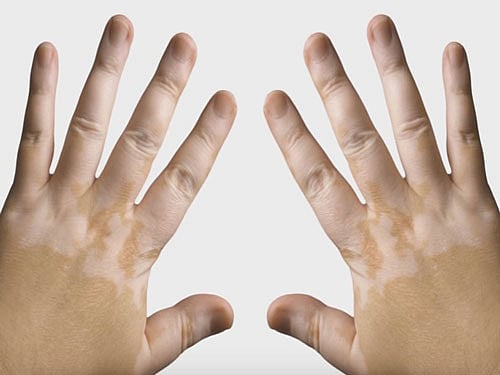 Vitiligo is a pigmentation disorder in which melanocytes (the cells that make pigment) in the skin are destroyed. File Photo for representation.