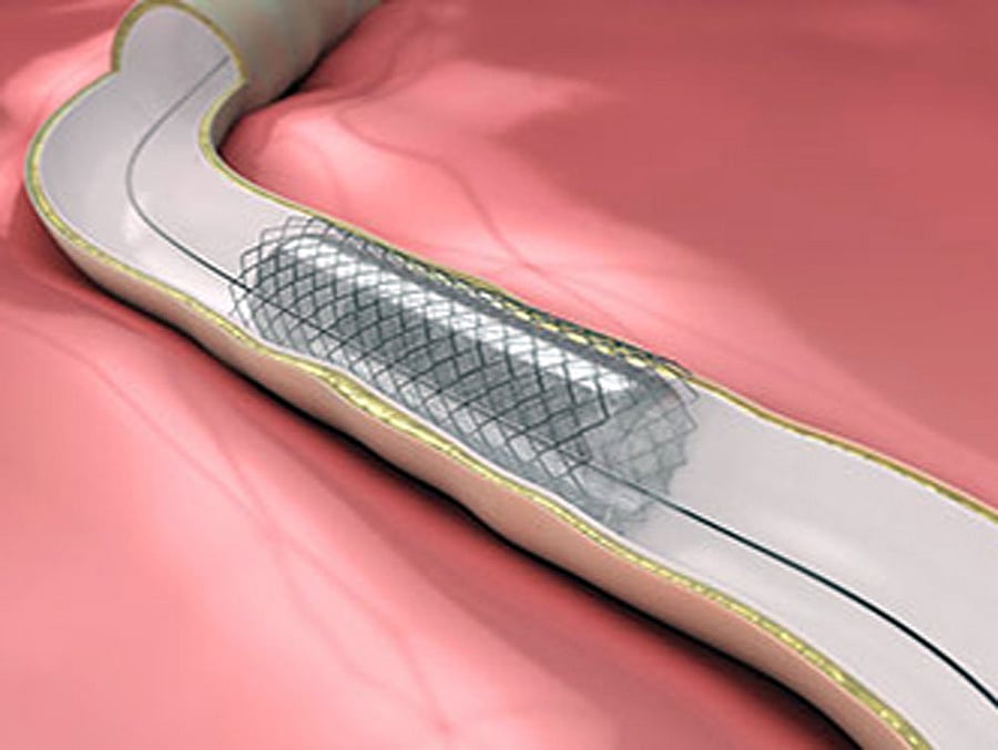 Coronary stents
