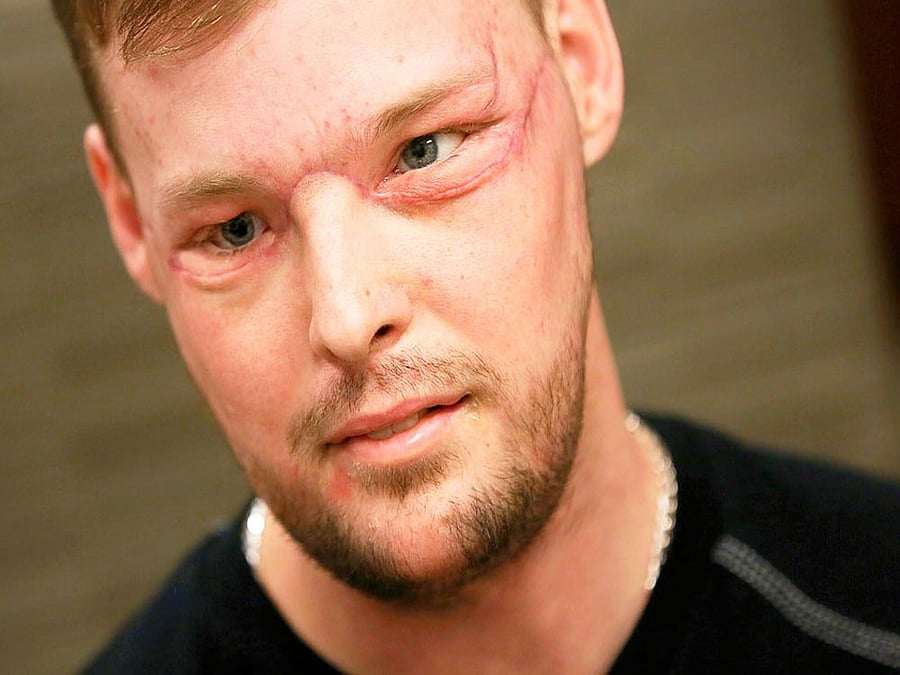 The surgery, which spanned more than 50 hours, was carried last year and involved restoring Sandness' nose, upper and lower jaw, palate, teeth, cheeks, facial muscles, oral mucosa, some of the salivary glands and the skin of the face. Screengrab