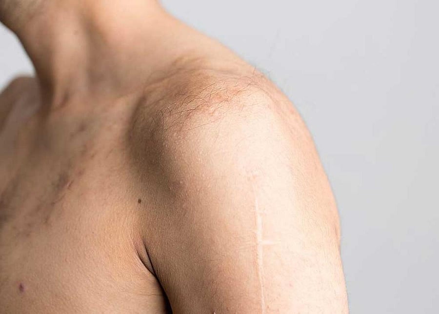 Studies found that the difference between the effectiveness of a placebo surgery and a common surgery in the case of shoulder impingement were minimal. Wikipedia photo for representation.