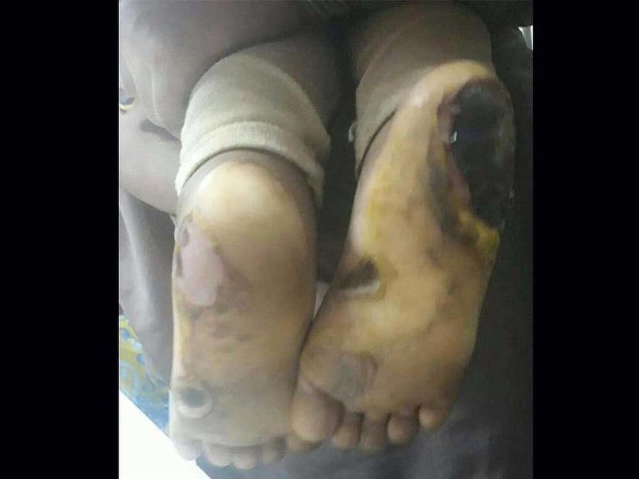 The child Rupali (name changed) who received third-degree burns on her buttocks and feet has been shifted child care centre in Sisuvihar and the culprits have been arrested. DH Photo