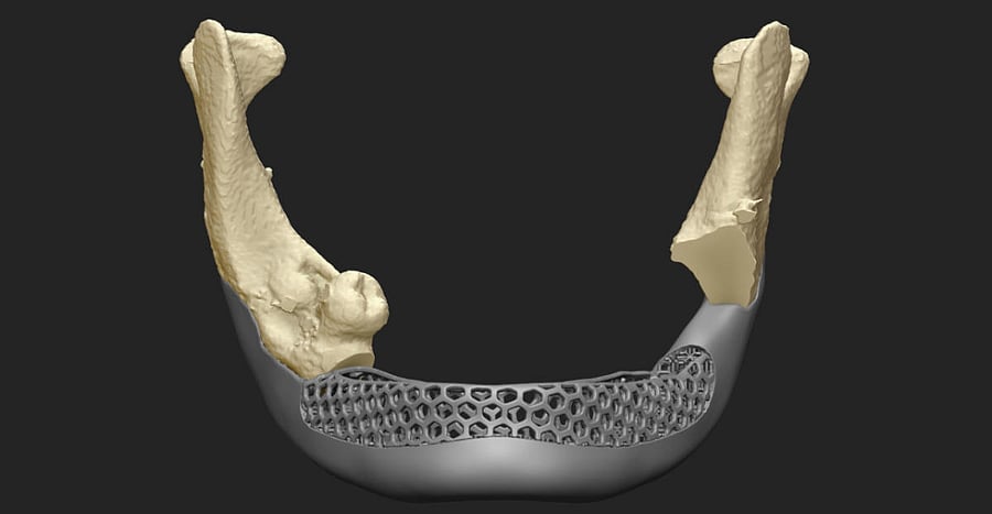 Hussain could not close his mouth and had difficulty in swallowing due to lack of skeletal support. Despite undergoing multiple reconstructive surgeries and visiting various countries for the same, he finally found some relief at the Manipal Hospital in Malleswaram.