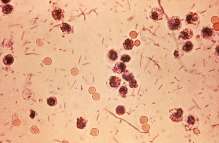 This photomicrograph revealed stool exudates in a patient with shigellosis, which is also known as “Shigella dysentery”, or “Bacterial dysentery”. Usually, those who are infected with Shigella develop diarrhea, which is often bloody, fever, and stomach cramps starting a day or two after they are exposed to the bacterium. Shigellosis usually resolves in 5 to 7 days. Wiki Commons. 