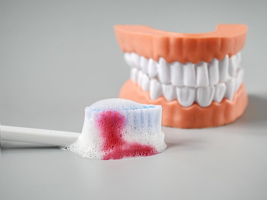 Hereditary traits and factors such as obesity, education and personality may play a role in tooth decay and gum disease, according to a study. (FilE Photo)
