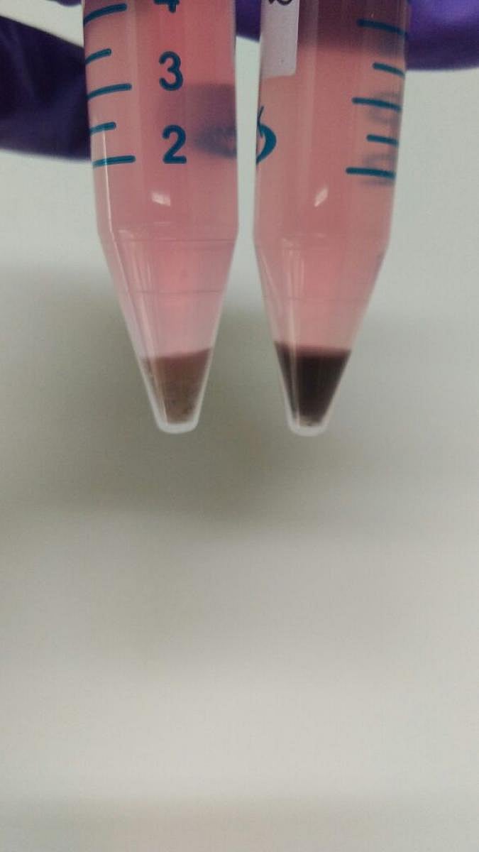 Two vials showing stem cell modified Retinal Pigment Epithelium cells (which appear brown/black). The quantity of each vial is enough for five patients.  PIC Courtesy: Dr Jogin Desai (inset)