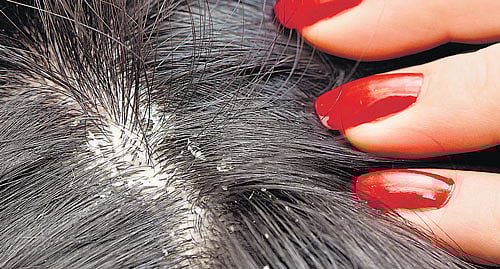 Fighting dandruff head on