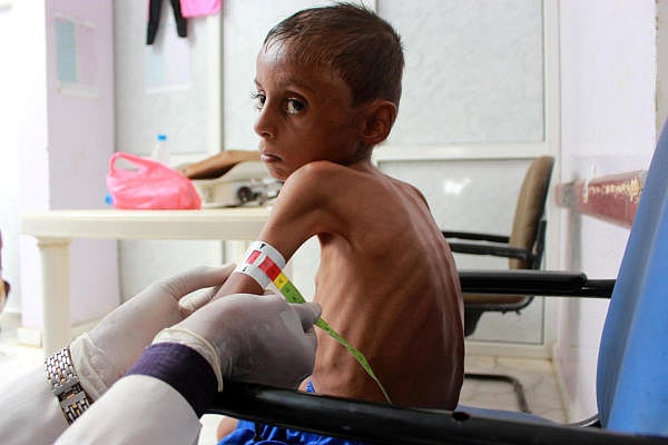 Doctor measure the arm of malnourished boy. Credit: Reuters