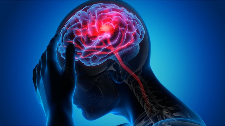 Those Covid-19 patients who were hospitalized or placed on ventilators showed an average drop of seven IQ points. Credit: iStockPhoto