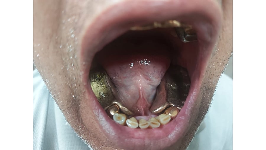 The smuggled gold brought in as dentures. Credit: Twitter/@Delhicustoms