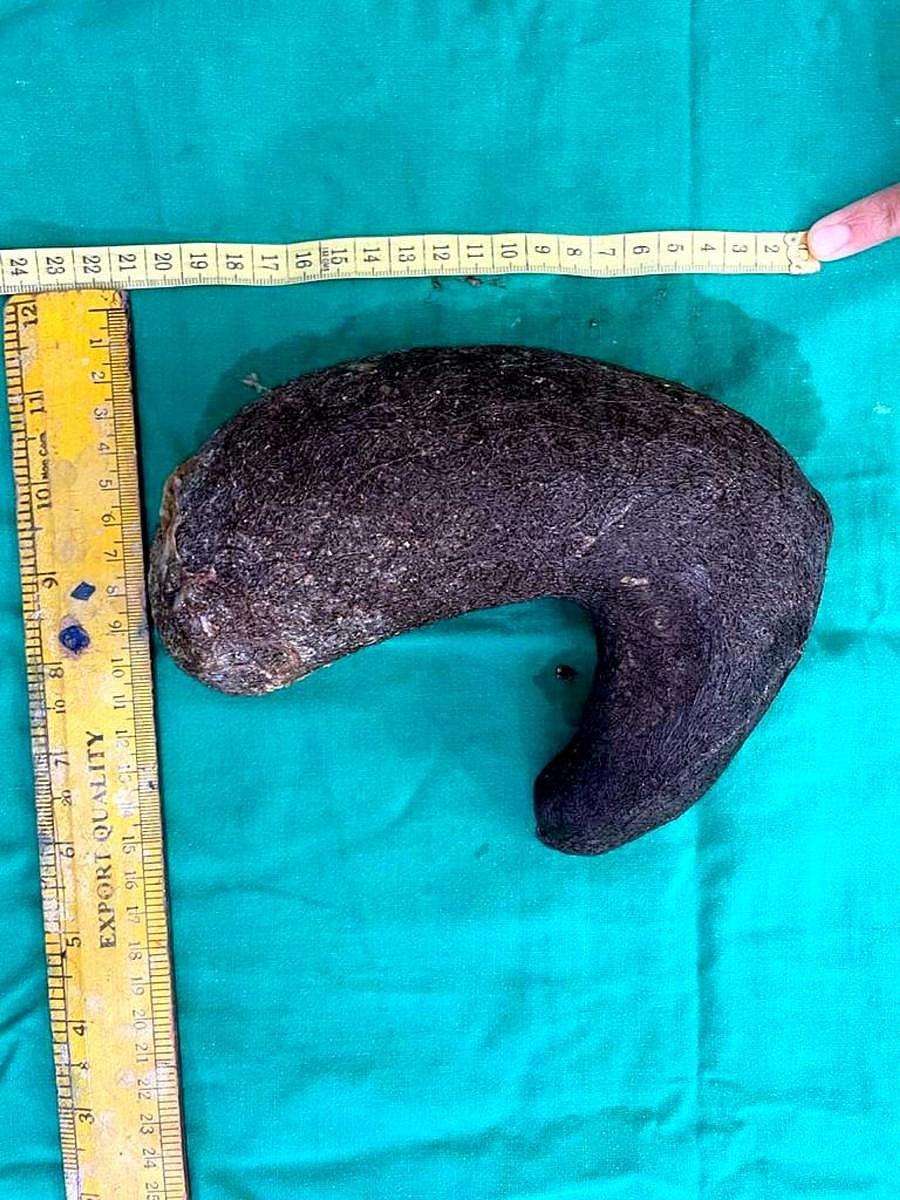 Hair removed from the woman's stomach.