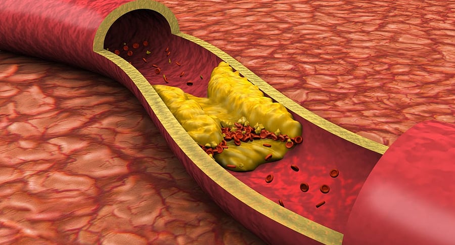 Clogged Artery Low Angle View (3D). Credit: Getty Images