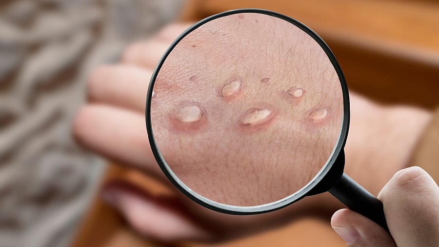 The virus is transmitted through close contact with infected animals, mostly rodents, or humans. Credit: iStock Photo