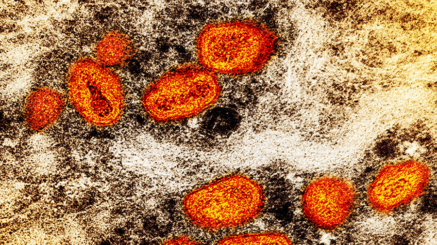 This image shows a colorized transmission electron micrograph of monkeypox particles (orange) found within an infected cell (brown). Credit: AP/PTI Photo