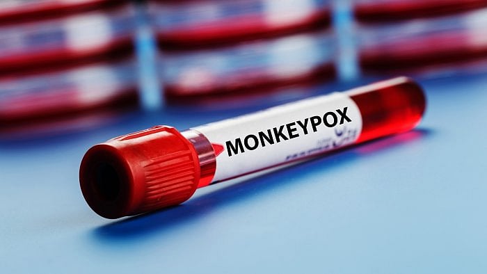 The UK Health Security Agency (UKHSA) said preliminary genomic sequencing indicates that this new case does not have the current outbreak strain circulating in the UK. Credit: IANS Photo