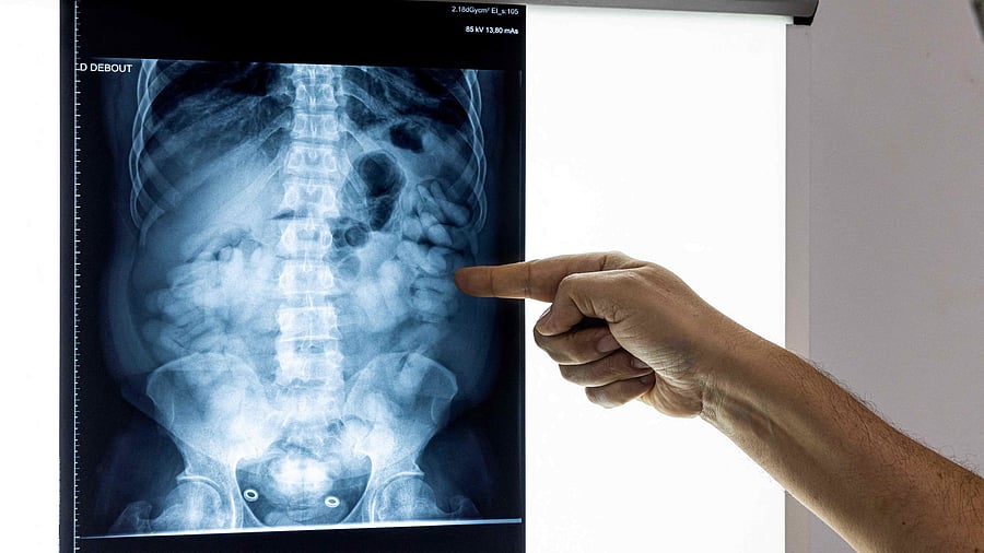 This file photo taken on October 14, 2022, shows Dr Karim Hamiche, doctor in charge of the UMJ (Unité Médico Judiciaire), at the hospital in Cayenne, looking at an abdominal X-ray, where cocaine ovules can be seen in the intestines of a mule, in Cayenne, French Guiana. Credit: AFP Photo