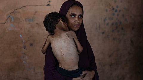 21 crianças morreram de fome em Gaza nas últimas 72 horas