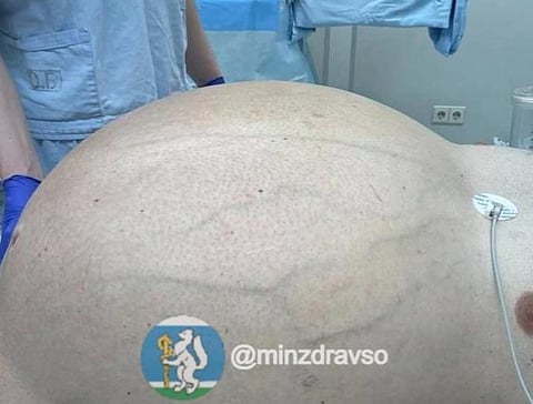 Médicos russos retiram tumor de mais de 60 quilos a paciente