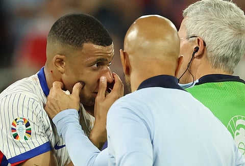 Mbappé terá que usar máscara para proteger fratura do nariz