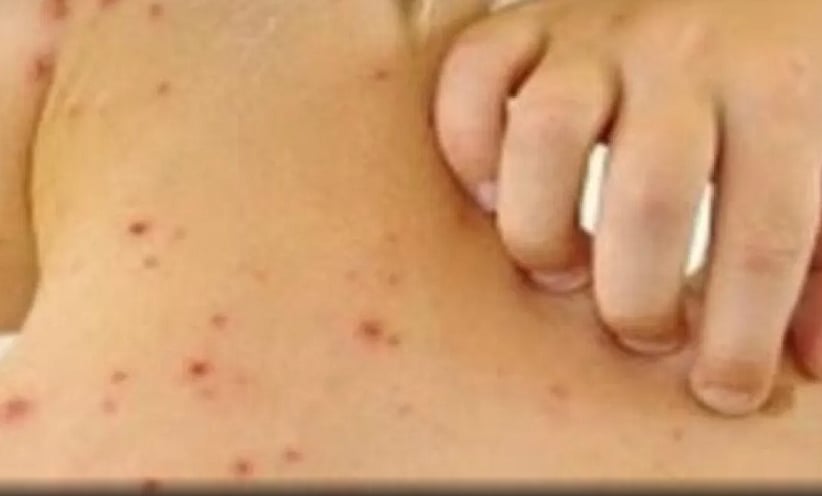Three measles cases and over 500 high-risk contacts in Beja