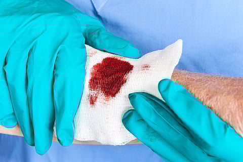 जेरोजेल ड्रेसिंग, सर्जरी और चोट लगने के दौरान खून बहने से होने वाली हानि, विकलांगता और मृत्यु दर को कम करने के लिए एक हेमोस्टेटिक या रक्तसंचारी समाधान हो सकता है। 