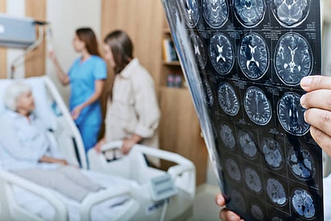 दुनिया भर में लगभग 40 लाख लोग पार्किंसंस रोग से पीड़ित हैं, यह एक प्रगतिशील न्यूरोलॉजिकल बीमारी है जो मस्तिष्क में कुछ संरचनाओं को प्रभावित करती है।